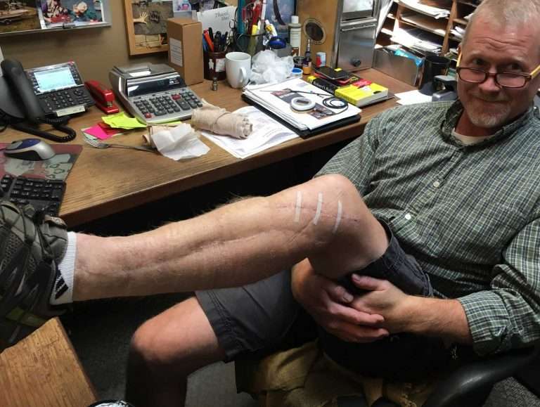 post leg surgery in office