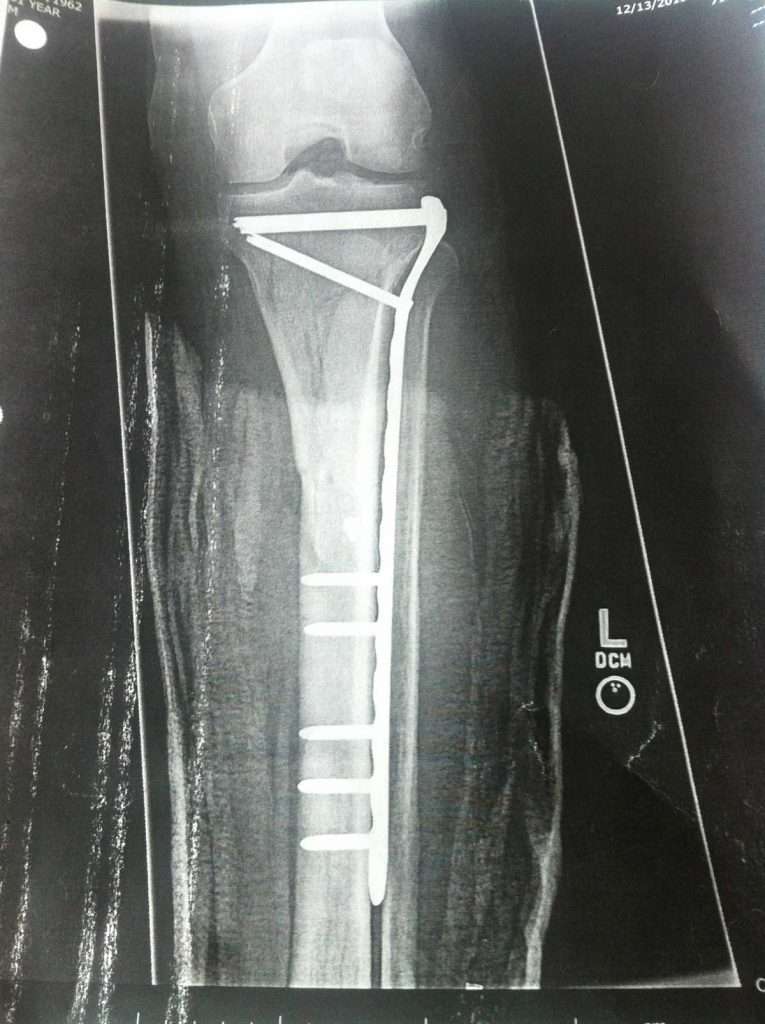 x ray of leg