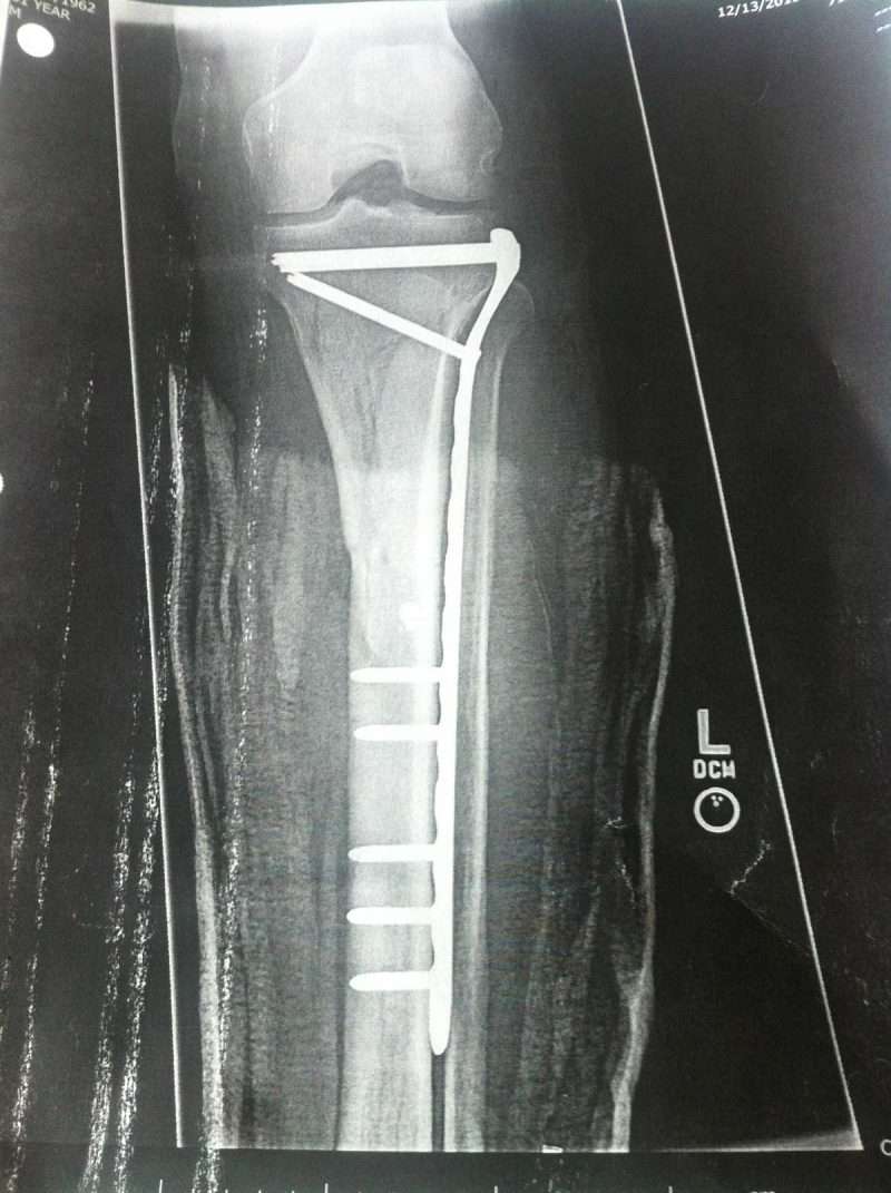 x ray of leg